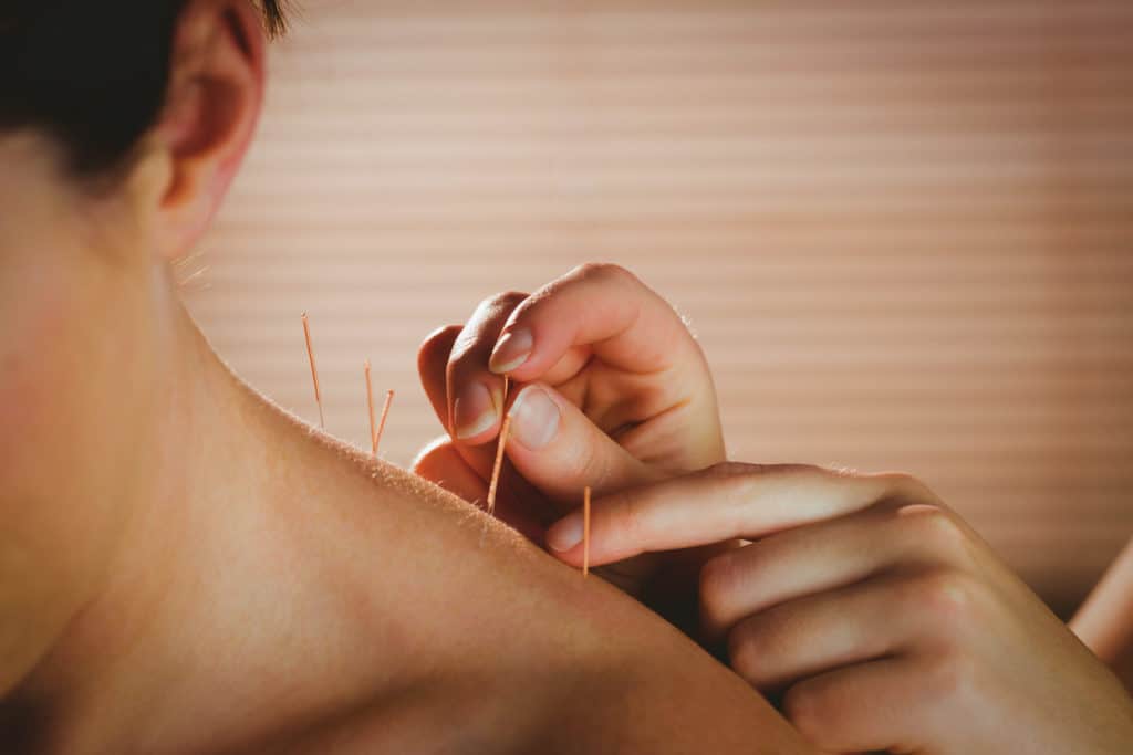 Dry Needling And Its Benefits
