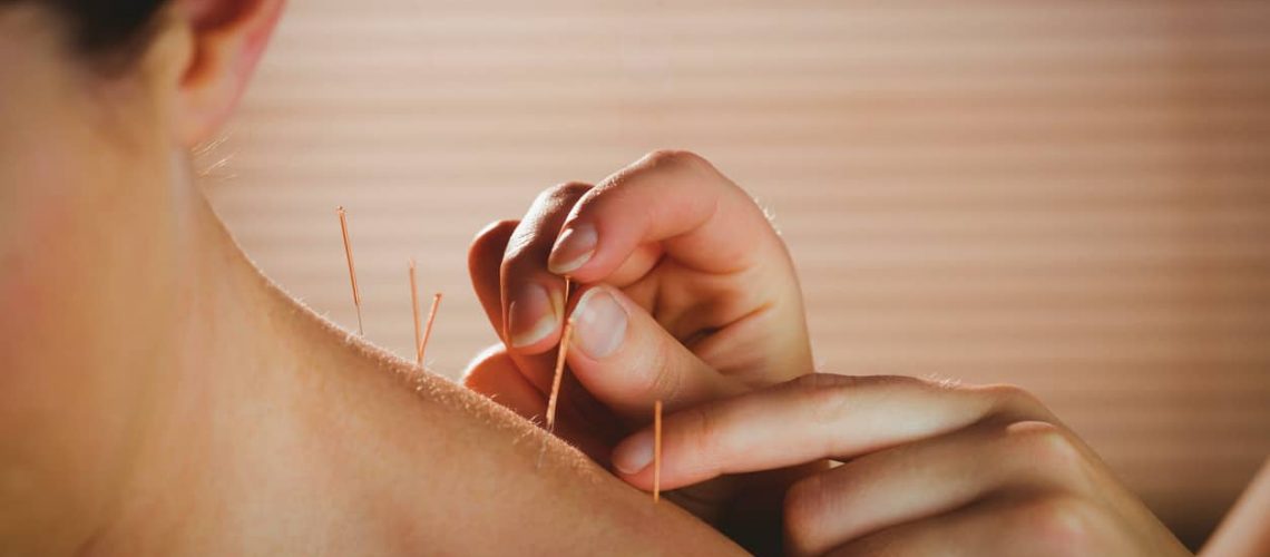 Dry Needling And Its Benefits